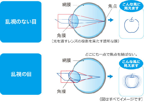 new_乱視